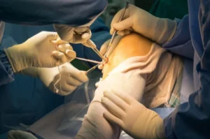 ACL Reconstruction------16