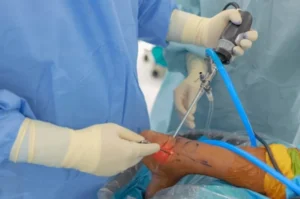 Ankle Arthroscopy