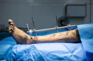 Bone Fracture Fixation