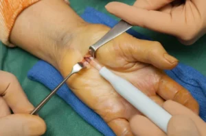 Endoscopic Carpal Tunnel Surgery------16