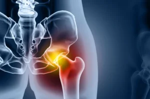 Hip Replacement Surgery