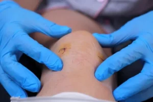 Knee Arthroscopy------16