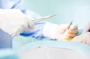 Laminectomy-------16